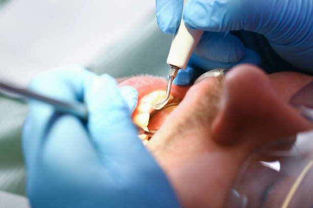 Best Emergency Root Canal Treatment in Old Fig Garden, CA